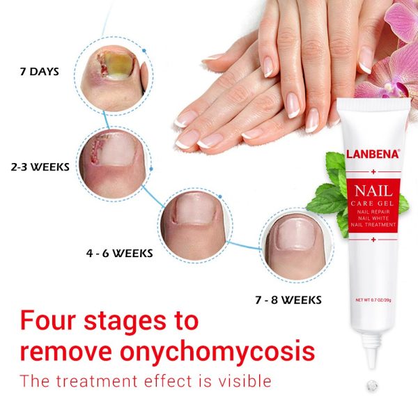 LANBENA Fungal Nail Repair Serum Care Treatment Foot Nail Fungus Removal Gel Anti Infection Paronychia Onychomycosis Essence