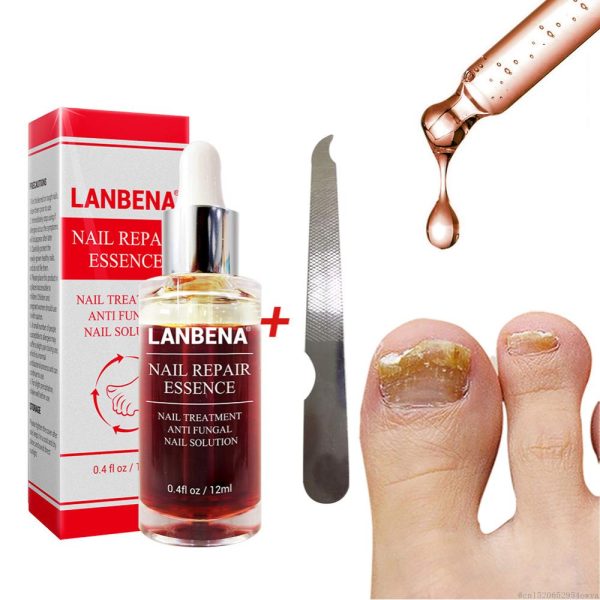 LANBENA Fungal Nail Repair Essence Serum Care Treatment Foot Nail Fungus Removal Gel Anti Infection Paronychia Onychomycosis