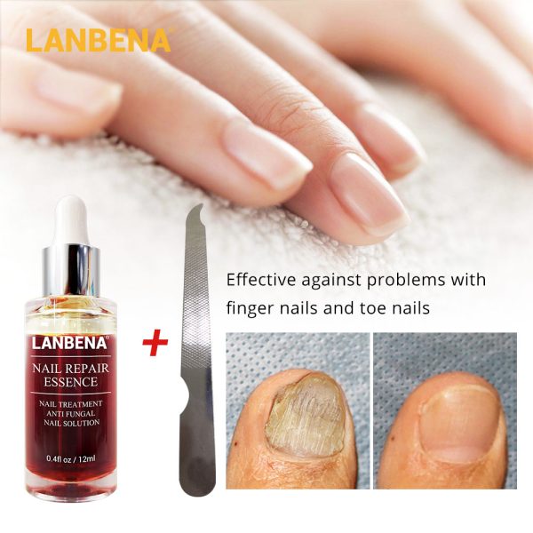 LANBENA Fungal Nail Repair Essence Serum Care Treatment Foot Nail Fungus Removal Gel Anti Infection Paronychia Onychomycosis