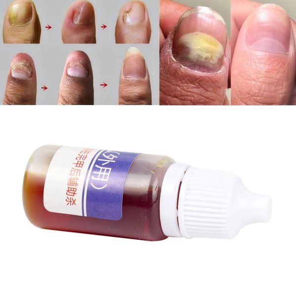 Nail Repair Fungal Nail Treatment Remove Toe Onychomycosis Remover Serum Nail Fungus Repair Treatment for Health Skin Care TSLM1