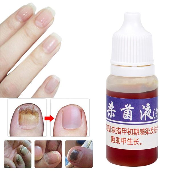 Nail Repair Fungal Nail Treatment Remove Toe Onychomycosis Remover Serum Nail Fungus Repair Treatment for Health Skin Care TSLM1