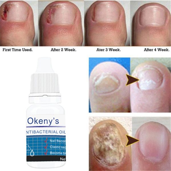 3 Days Effect Fungus Removal Essence Liquid Fungal Nail Treatment Bright Nail Repair Anti Infection Foot Caring Onychomycosis