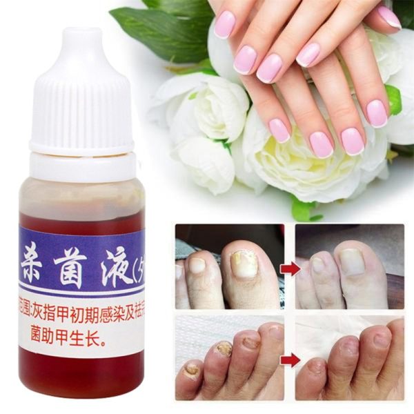 Nail Repair Fungal Nail Treatment Remove Toe Onychomycosis Remover Serum Nail Fungus Repair Treatment for Health Skin Care TSLM1