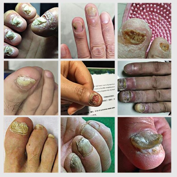 LANBENA Fungal Nail Repair Serum Care Treatment Foot Nail Fungus Removal Gel Anti Infection Paronychia Onychomycosis Essence