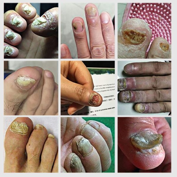 LANBENA Fungal Nail Repair Essence Serum Care Treatment Foot Nail Fungus Removal Gel Anti Infection Paronychia Onychomycosis