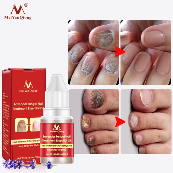 Meiyanqiong Lavender Fungal Nail Treatment Essential Oil Promote Nails Grow Healthy Nail Treatment Onychomycosis Foot Care