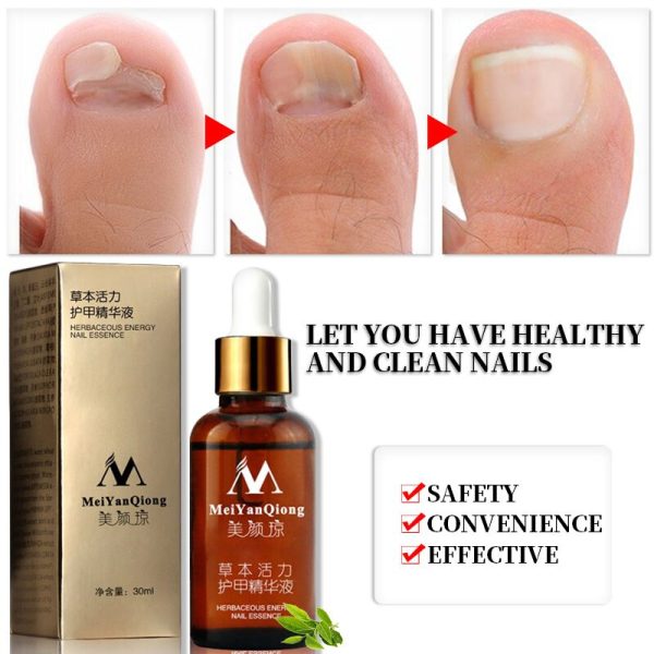 NEW!!!Fungal Nail Treatment Essence Nail and Foot Whitening Toe Nail Fungus Removal Feet Care Nail Gel Free Shipping