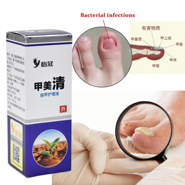 Best Fungus Nail Treatment Cream Onychomycosis Paronychia Anti Fungal Nail Infection Fights Bacteria And Fungus Naturally