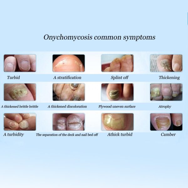 Best Fungus Nail Treatment Cream Onychomycosis Paronychia Anti Fungal Nail Infection Fights Bacteria And Fungus Naturally