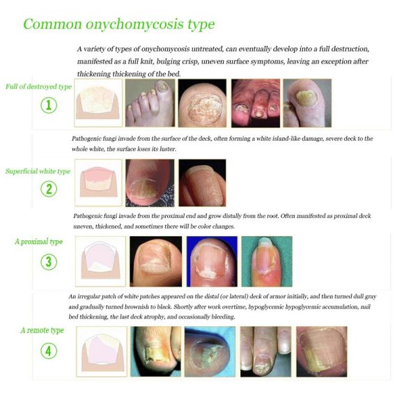 Best Fungus Nail Treatment Cream Onychomycosis Paronychia Anti Fungal Nail Infection Fights Bacteria And Fungus Naturally