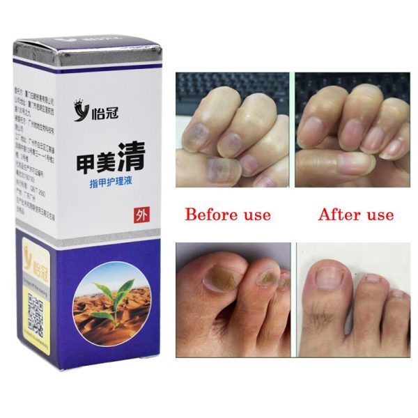 Best Fungus Nail Treatment Cream Onychomycosis Paronychia Anti Fungal Nail Infection Fights Bacteria And Fungus Naturally