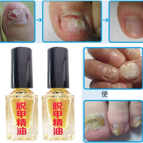 5ml Effect Fungus Removal Essence Liquid Fungal Nail Treatment Bright Nail Repair Anti Infection Foot Caring Onychomycosis D242