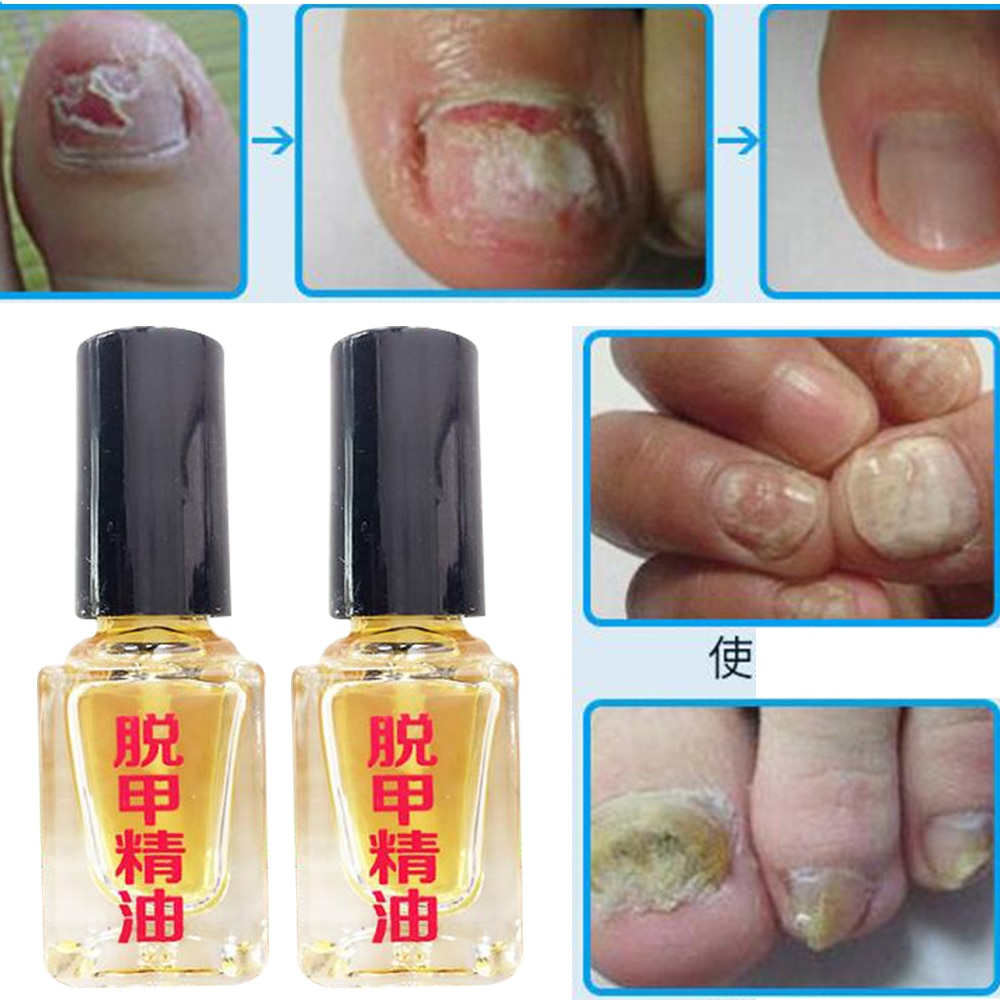 5ml Effect Fungus Removal Essence Liquid Fungal Nail Treatment Bright Nail Repair Anti Infection Foot Caring Onychomycosis D242